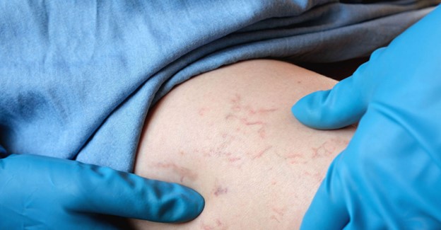 Prevention of Spider Veins During Pregnancy, Melbourne