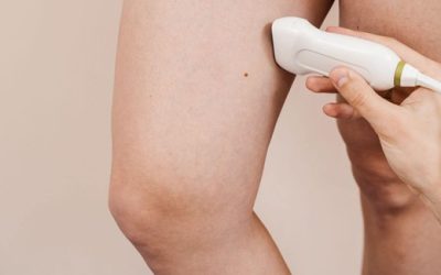 4 Tips for Maintaining Vein Health at Work in Melbourne