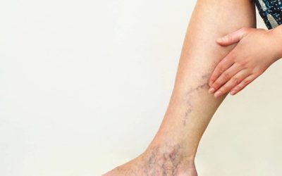 The Most Common Myths About Varicose Veins Melbourne