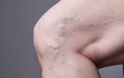 The Link Between Obesity and Varicose Veins Melbourne