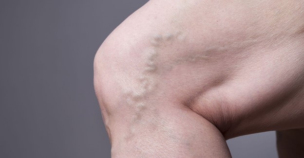 The Link Between Obesity and Varicose Veins Melbourne
