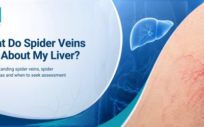 What Do Spider Veins Say About My Liver?