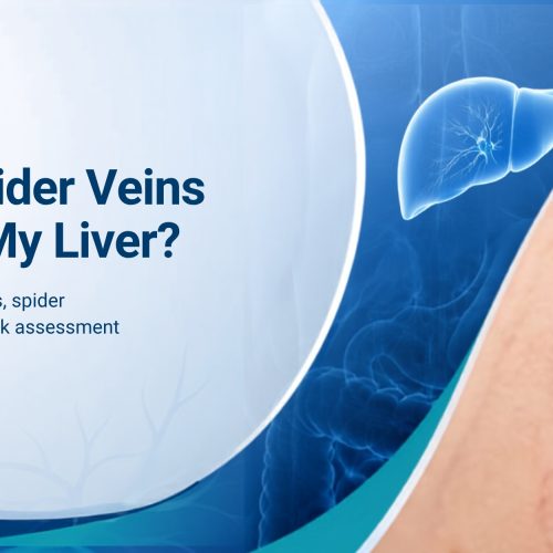 What Do Spider Veins Say About My Liver?