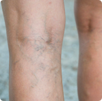 Reticular Veins Treatment in Melbourne