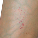 Spider Vein Therapies in Melbourne