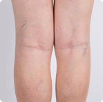 Varicose veins Treatment in Melbourne
