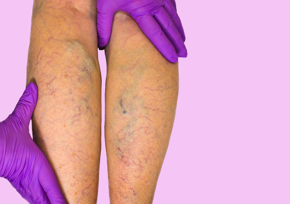 Varicose Vein Myths by Vein Care in Melbourne