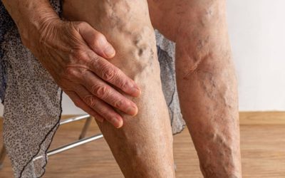 Deep Vein Thrombosis Symptoms: What to Look For