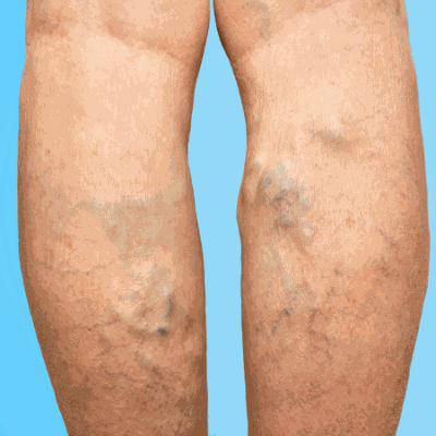 Bulging Veins