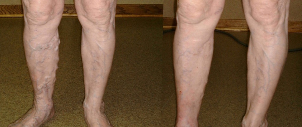 Before and After Results of Endovenous Laser Treatment in Melbourne