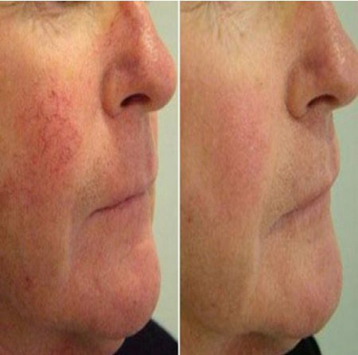 Reticular Veins Treatment in Melbourne